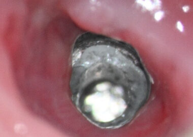 3 Preop clinical views of the zirconia fragment and in the right 2 images the reflection at 12:00 and 1:00 are implant defects from zirconia drilling 3 Preop clinical views of the zirconia fragment and in the right 2 images the reflection at 12:00 and 1:00 are implant defects from zirconia drilling