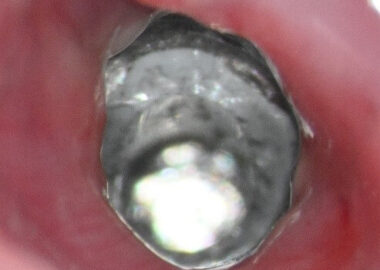 3 Preop clinical views of the zirconia fragment and in the right 2 images the reflection at 12:00 and 1:00 are implant defects from zirconia drilling 3 Preop clinical views of the zirconia fragment and in the right 2 images the reflection at 12:00 and 1:00 are implant defects from zirconia drilling