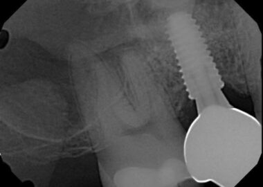 Preop image from Dr. S