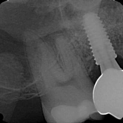 mastrovich-dental_case-study-eb-1 Preop image from Dr. S