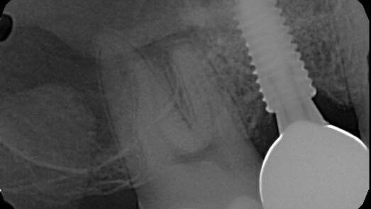 Preop image from Dr. S