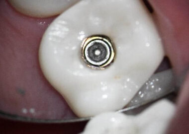 Preop crown and screw geometry