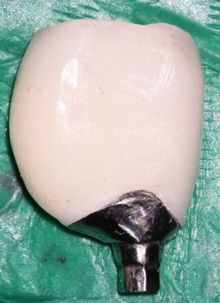mastrovich-dental_case-study-gb-001 Mesial view of crown- note the buccal cantilever