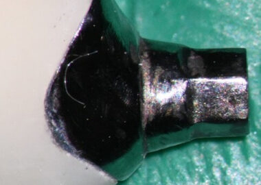 mastrovich-dental_case-study-gb-007 Crown and abutment view 1