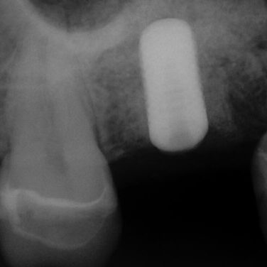 mastrovich-dental_case-study-tibase-aubtment-001 Supplied pre-op radiograph