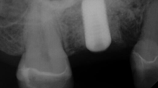 Supplied pre-op radiograph