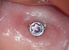 mastrovich-dental_case-study-tibase-aubtment-002 Cinical pre-op view with abutment screw still in place