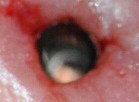 mastrovich-dental_case-study-tibase-aubtment-003 Clinical post -op views of the intact implant