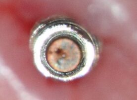 mastrovich-dental_case-study-tibase-aubtment-004 Clinical post -op views of the intact implant