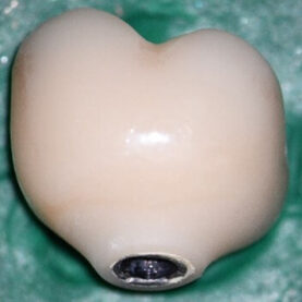 mastrovich-dental_case-study-tibase-aubtment-007 Recovered crown views to illustrate the thin the fractured titanium cylinder wall and the molar sized crown which supplies the leverage to create the torsional loading which fractured the cylinder.