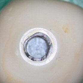 mastrovich-dental_case-study-tibase-aubtment-008 Recovered crown views to illustrate the thin the fractured titanium cylinder wall and the molar sized crown which supplies the leverage to create the torsional loading which fractured the cylinder.