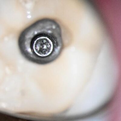 Abutment screw accessed