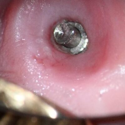 Crown removed with abutment screw up