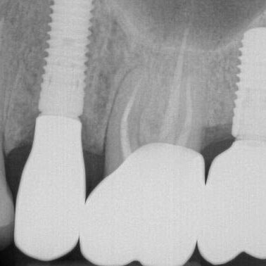 mastrovich-dental_case-study-wa-14 image supplied preoperatively