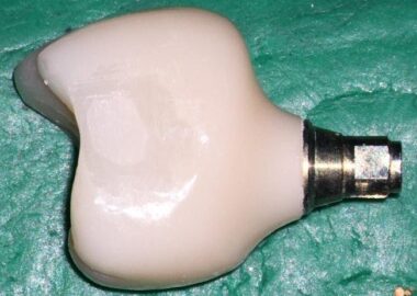 Abutment and crown with the NC abutment interface – Note the unexplained excentric end of the abutment.