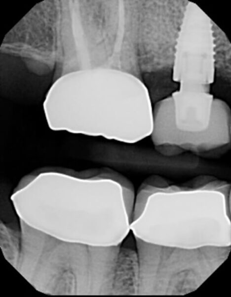 Preop radiograph