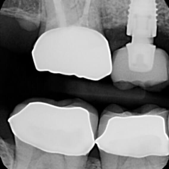 mastrovich-dental_case-study-wr-001 Preop radiograph