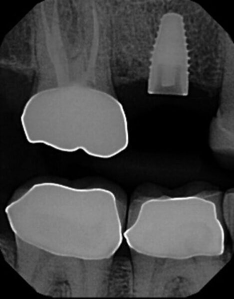 Note level of fractured abutment screw