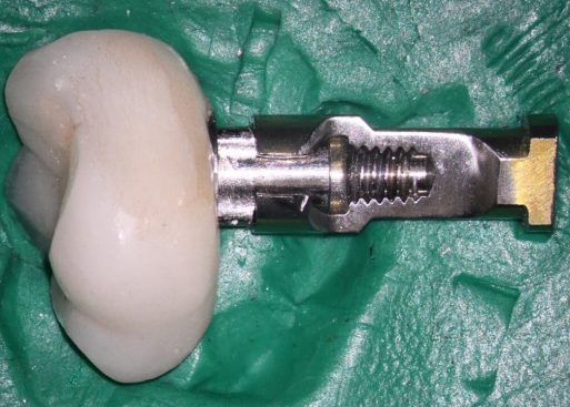 Patient’s abutment and crown placed on an opened trilobe Conical analog (Note lack of seating as in the preop. radiograph)