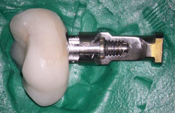 Patient’s abutment and crown placed on an opened trilobe Conical analog (Note lack of seating as in the preop. radiograph)