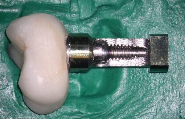 Patient’s abutment and crown placed on an opened Nobel Trilobe analog