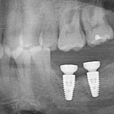 mastrovich-dental_sn-redected-narrative-case-study-1 Cropped preop pan from Dr. MM