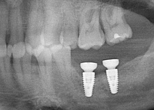 Cropped preop pan from Dr. MM