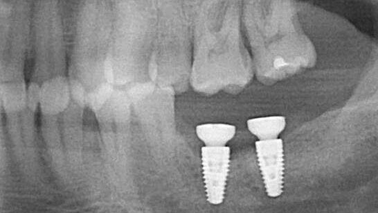 Cropped preop pan from Dr. MM