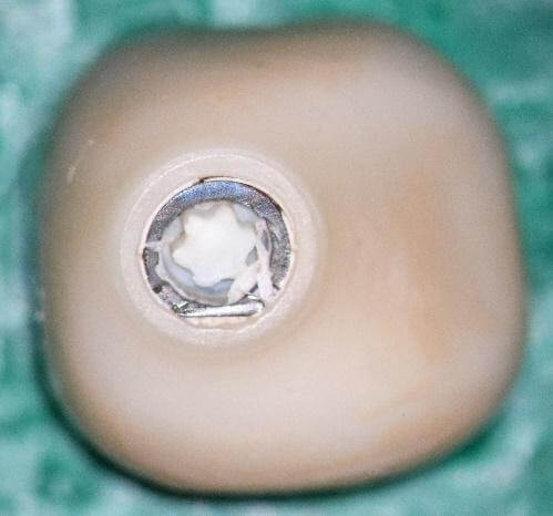 Crown fractured abutment interface