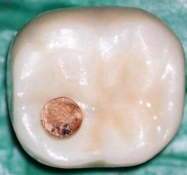 Crown occlusal view