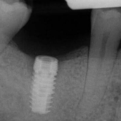preop radiograph feat preop radiograph