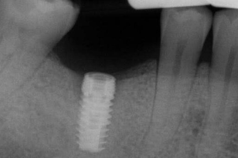 preop radiograph
